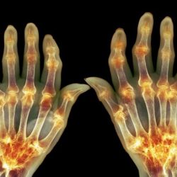 Arthritis rheumatoid