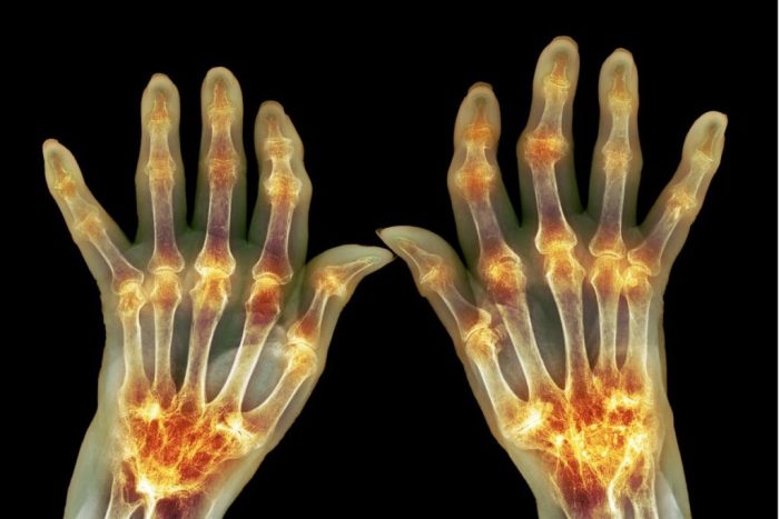 Arthritis rheumatoid