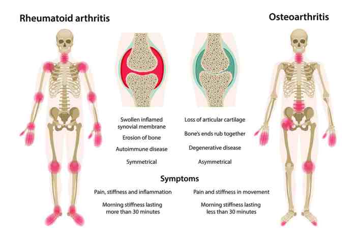 Which statement is true regarding rheumatoid arthritis and osteoarthritis